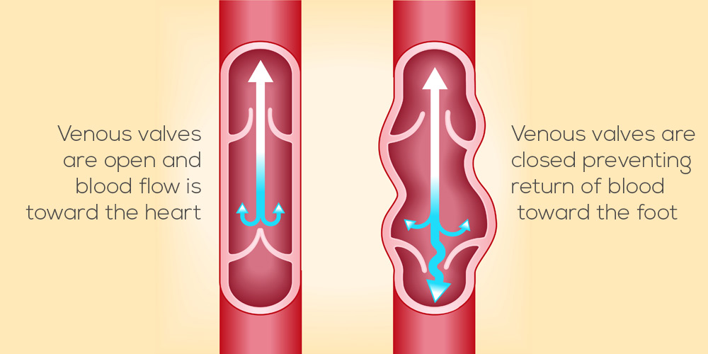 vein-illistration vein-illistration