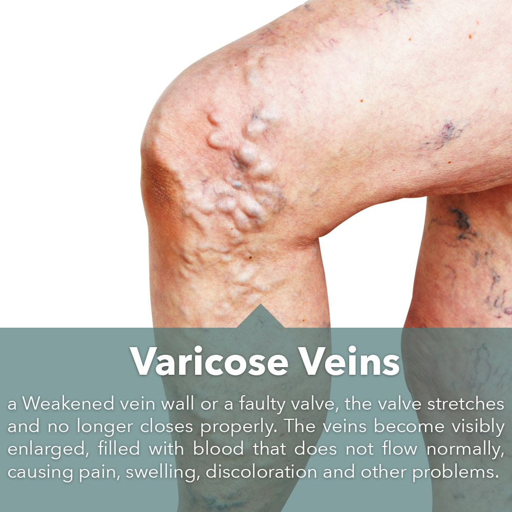 Home-Varicose-slide