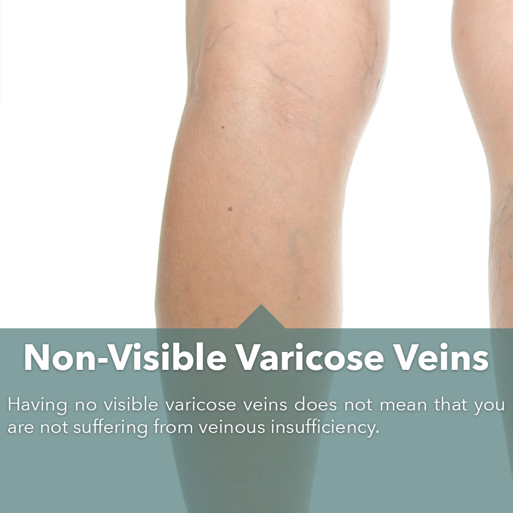 Non-visible-Veins-Slide-Home