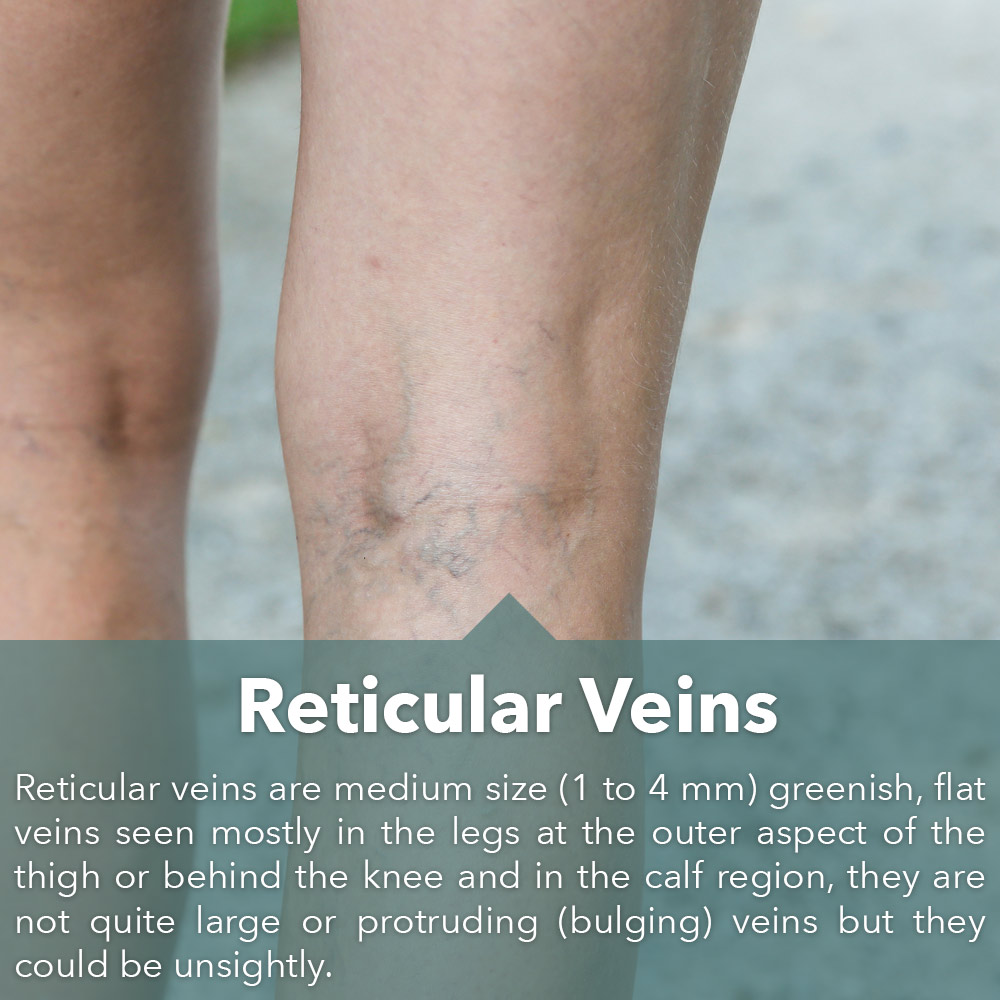 Reticular-veins-slide-home