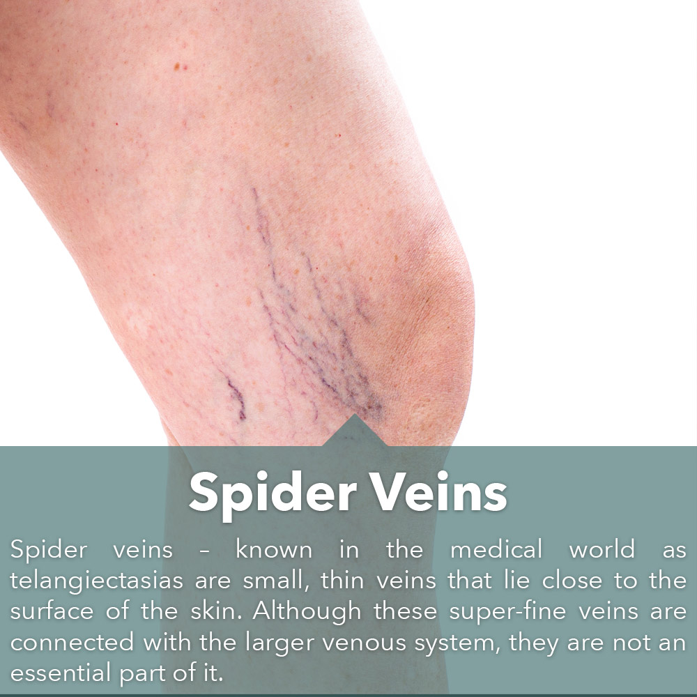 Spider-Veins-Slide-Home